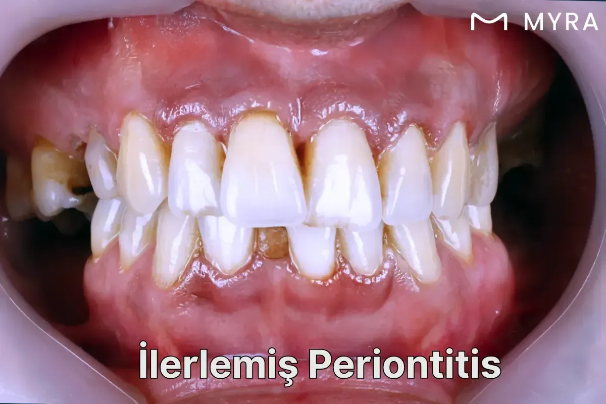 Periodontitis nedeniyle diş eti çekilmesi ve iltihaplı dokular