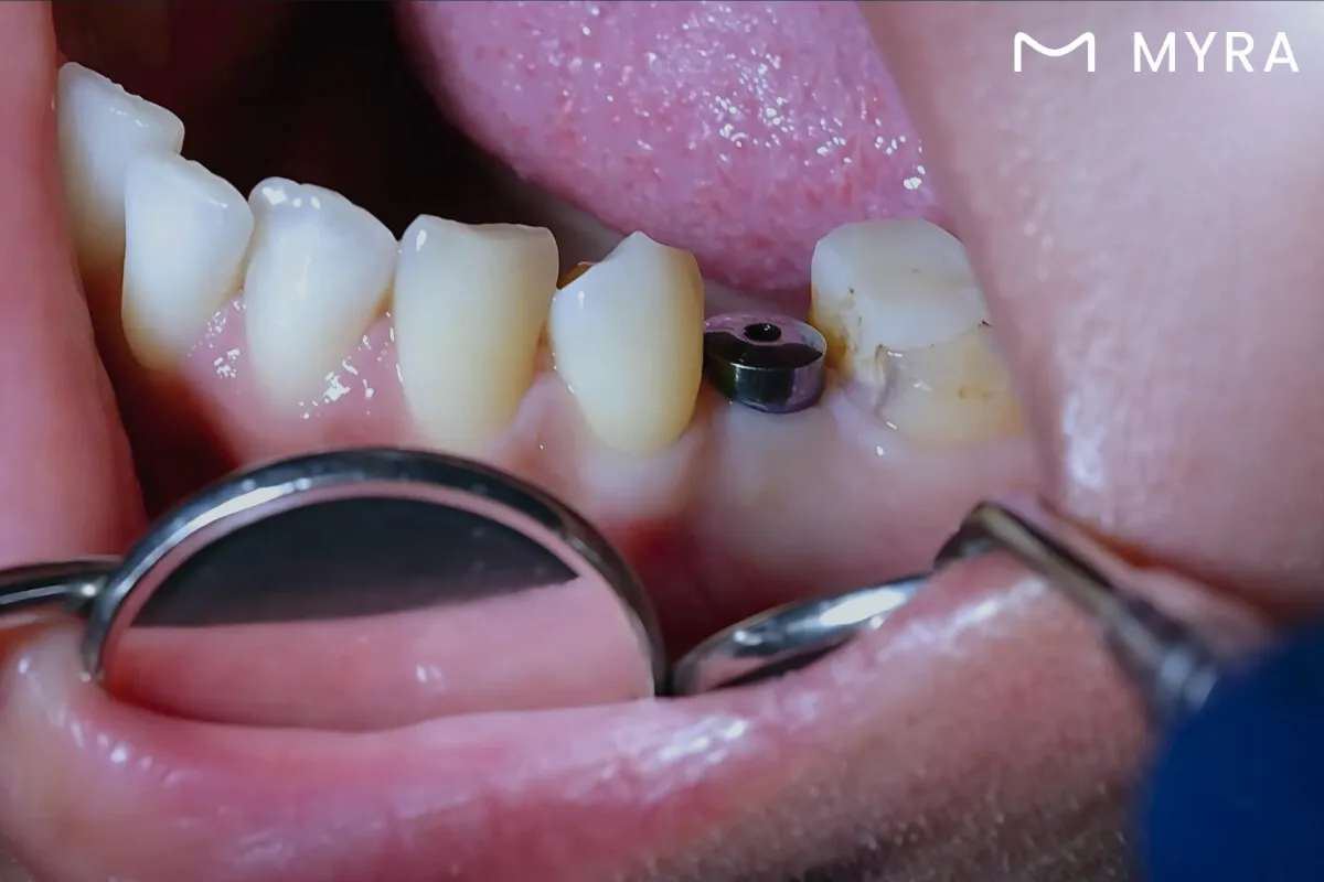 2-implant-1.webp