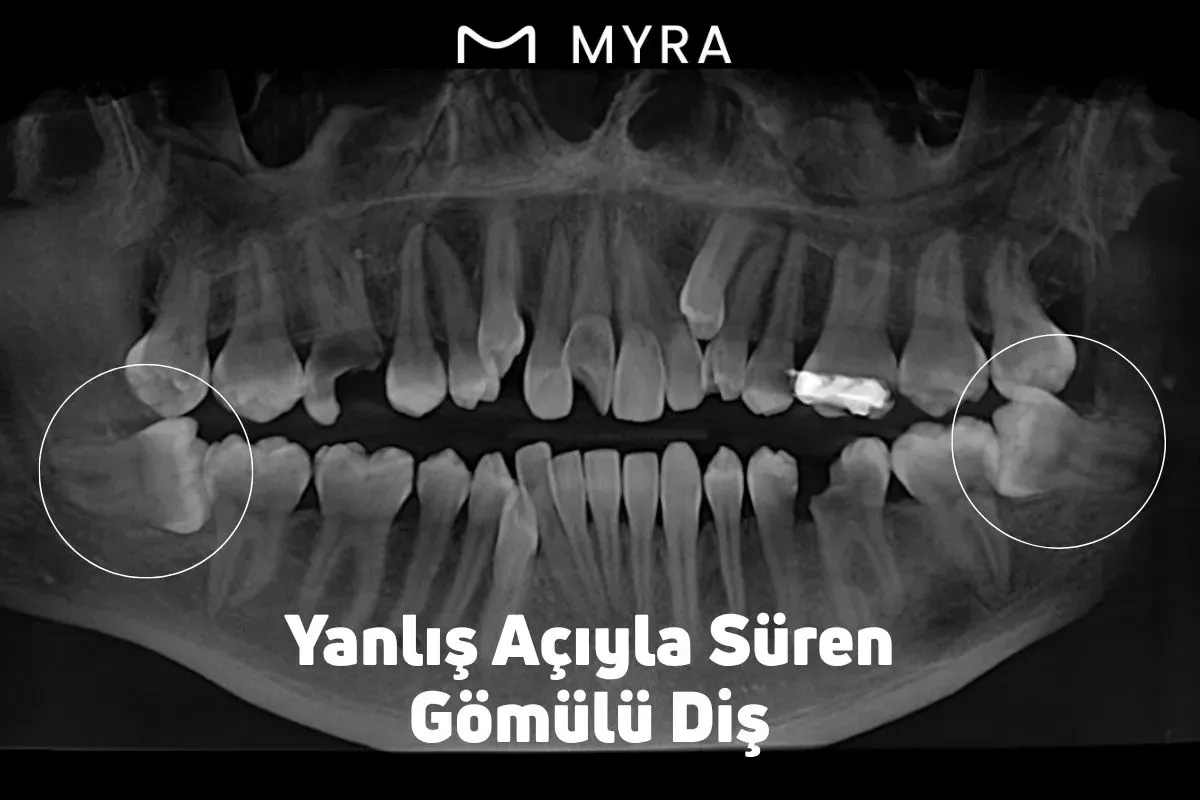 Diğer dişe baskı yapan eğik açıyla çıkan yirmilik diş görüntüsü