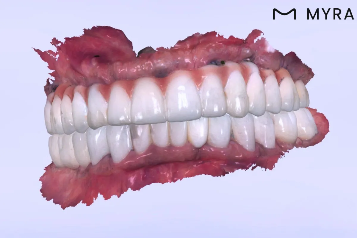 Bilgisayarlı ortamda hazırlanan 3D diş protezi planlaması