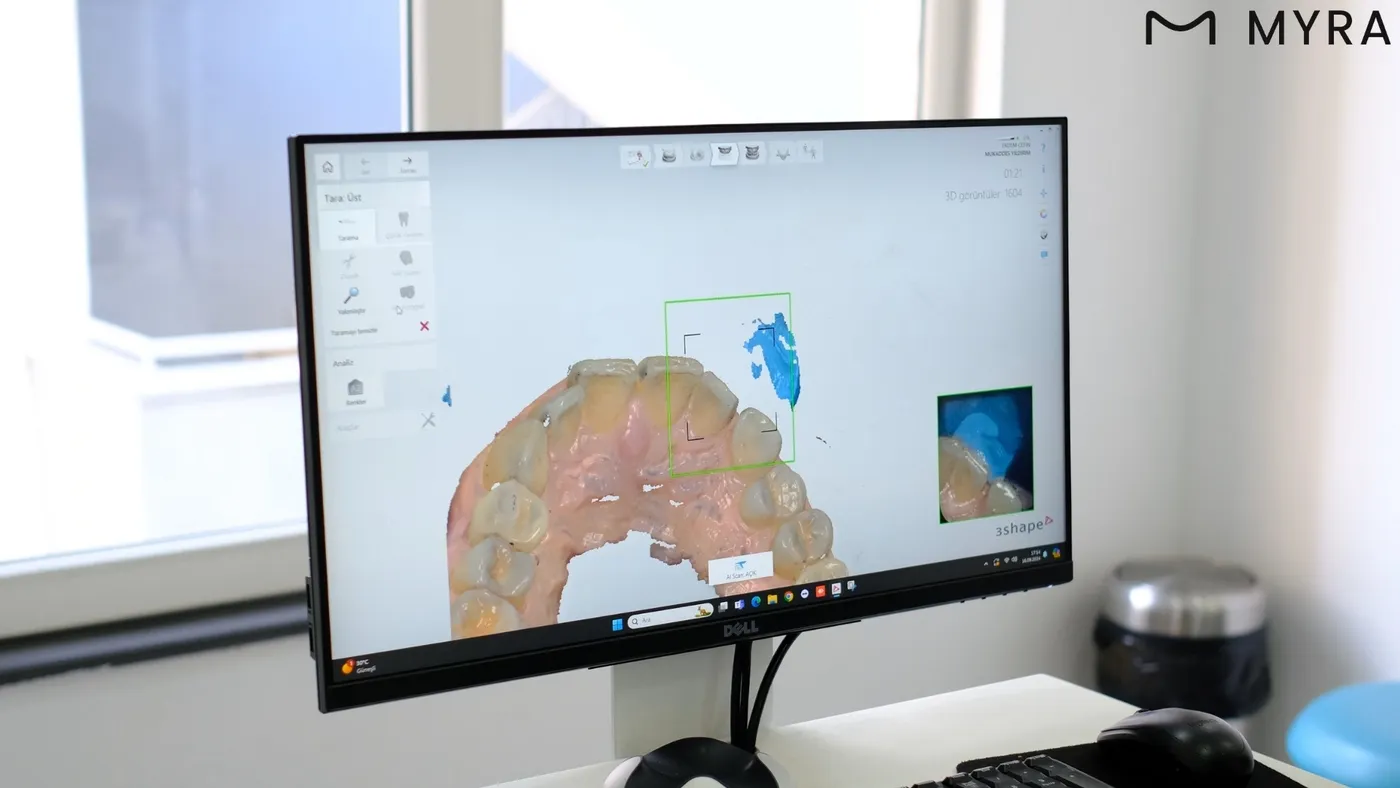 3D tarama ile elde edilen detaylı üst çene yapısı görselleştirmesi