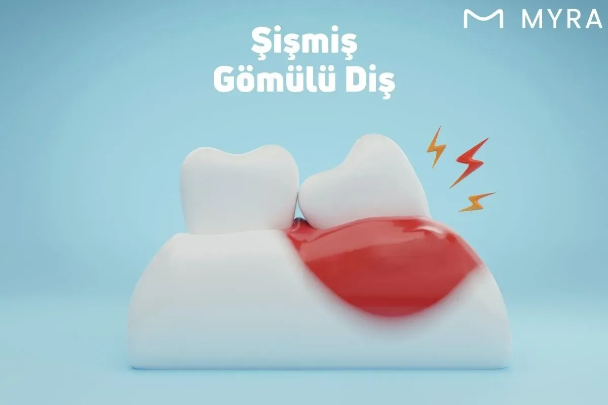 Şişlik ve kızarıklıkla birlikte ağrılı gömülü diş iltihap grafiği
