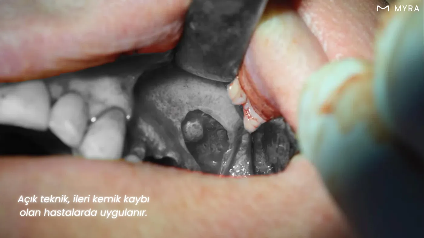  Lateral pencere tekniği ile sinüs lifting işlemi