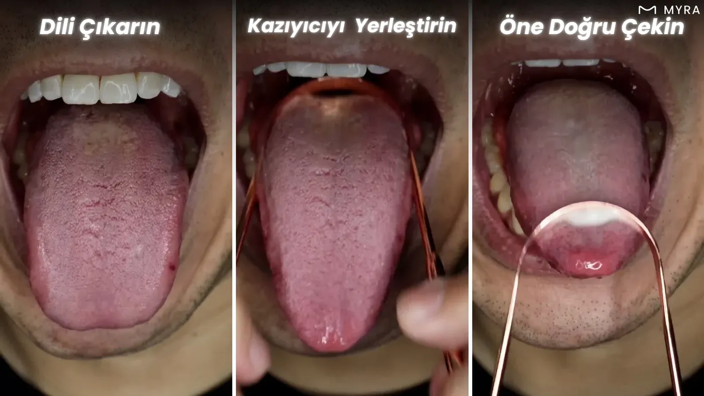 Dil sıyırıcı ile dilin arka bölgesinden öne doğru temizlik adımlarını gösteren infografik