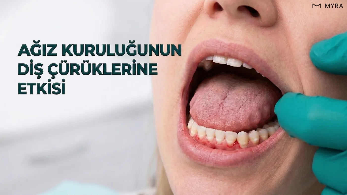 Tükürük azalmasına bağlı diş çürüğü oluşumunu gösteren diş modeli