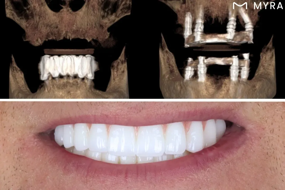 All-on-4 implant tedavisi nasıl yapılır