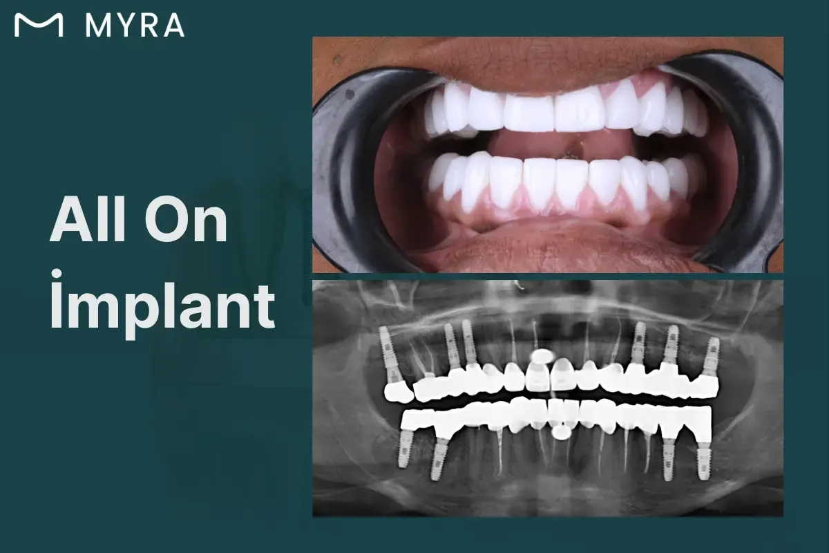 all-on-4-implant-tedavisi.webp