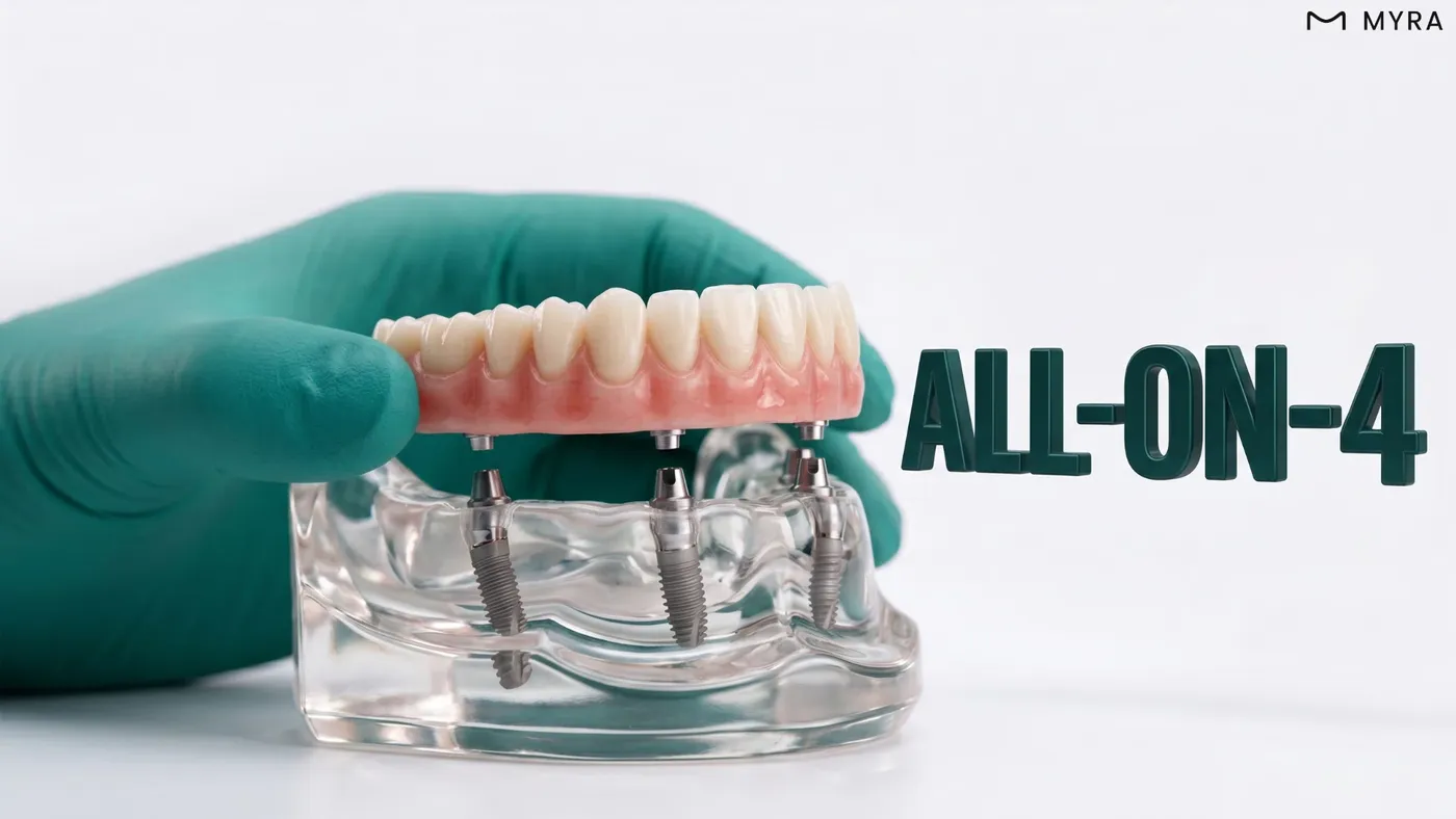 Dört implant üzerine monte edilen All-on-4 sabit tam diş köprüsünün çene modeli üzerinde gösterimi 