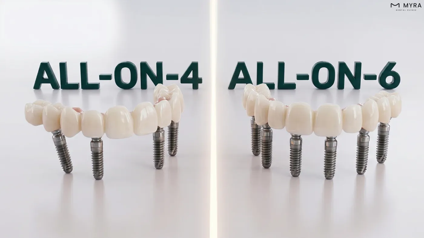 4 ve 6 implantlı tam çene sistemleri farkı