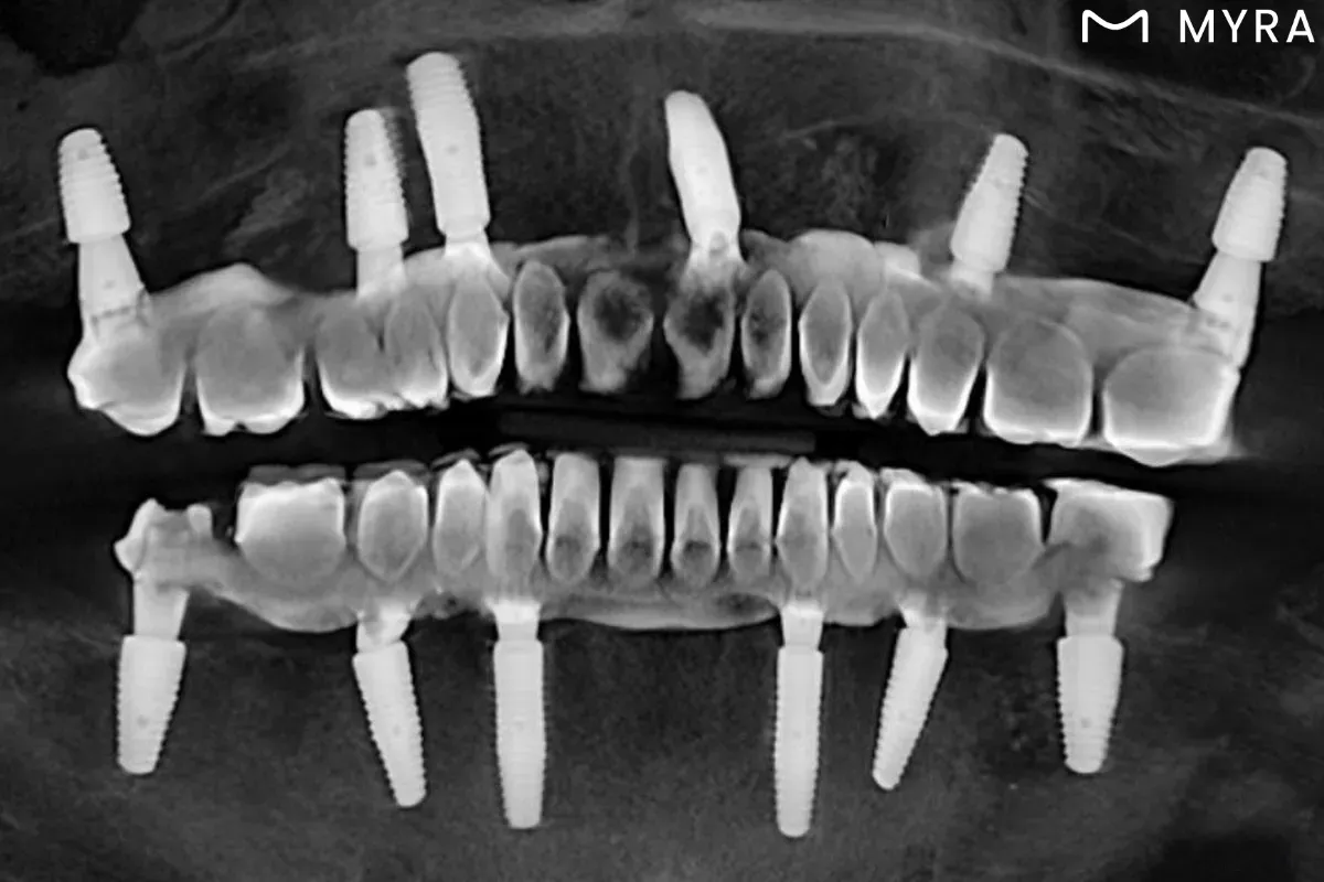 All-on-6 implant tedavisi