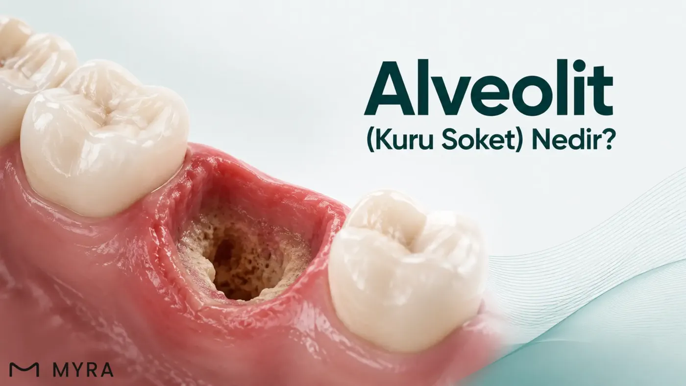 Kan pıhtısının kaybolduğu alveolit oluşumunu gösteren medikal çizim
