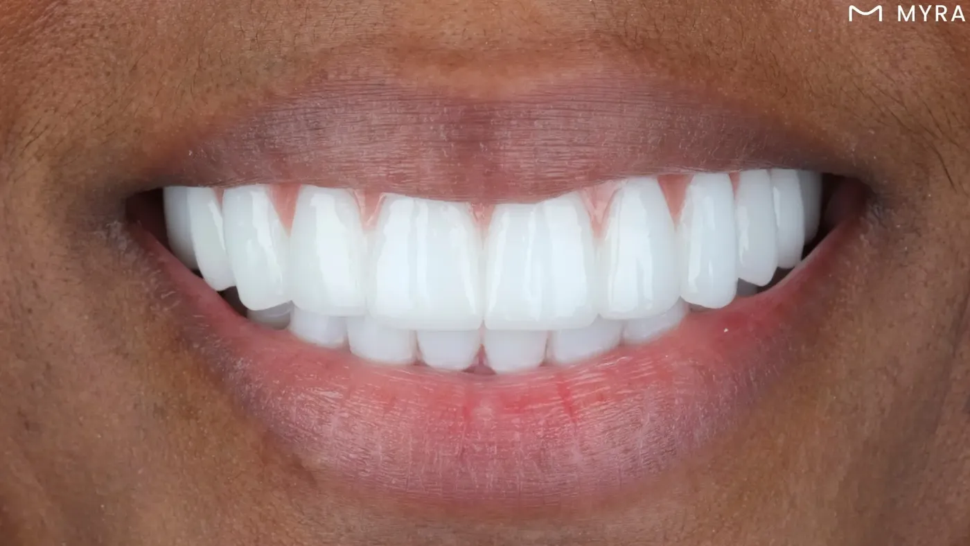 Antalya Myra Dental Hollywood gülüşü uygulamaları