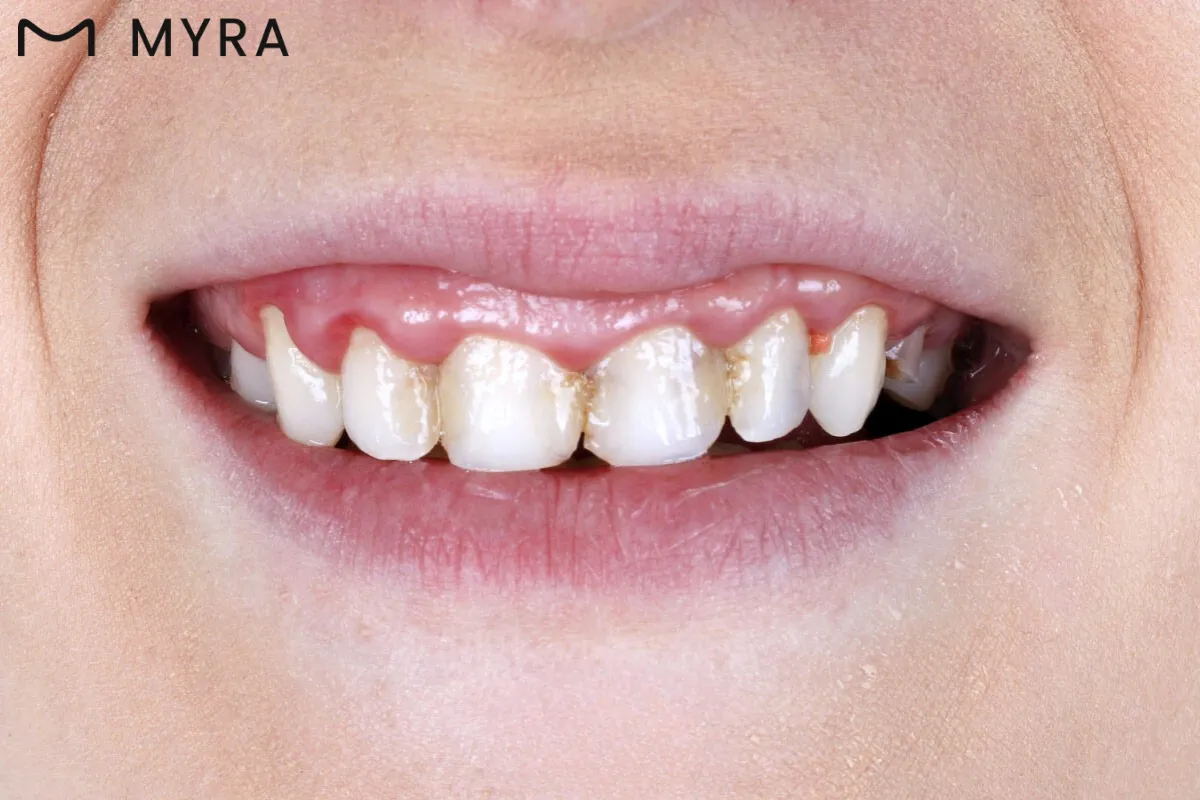 üst ön diş etlerinin belirgin olduğu anterior gummy smile tipi