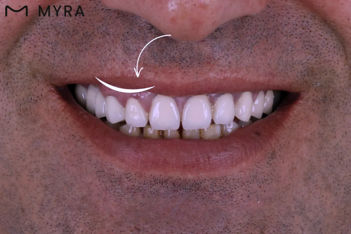 gülümsemede diş etlerinin orantısız şekilde göründüğü gummy smile örneği