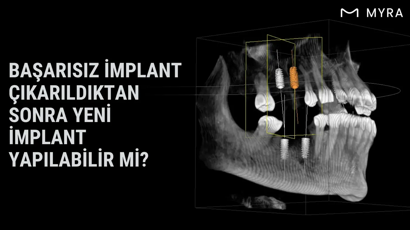 basarisiz-implantin-cikarilmasi-ve-yenilenmesi.webp