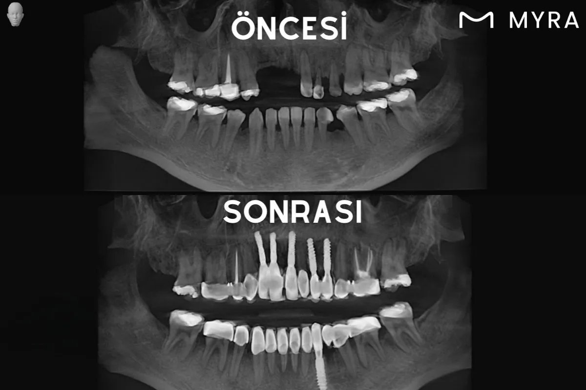 İmplant tedavisi öncesi ve sonrası diş röntgeni