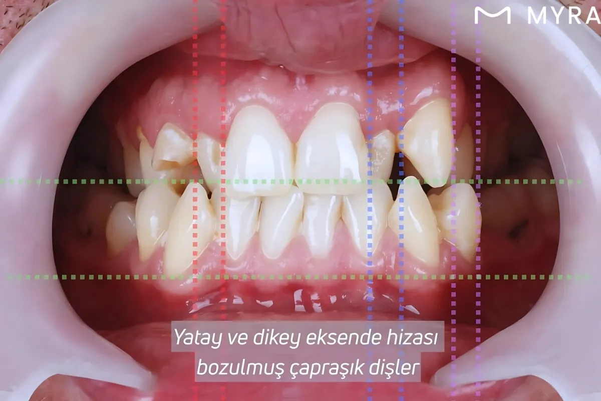 caprasik-disler-1.webp