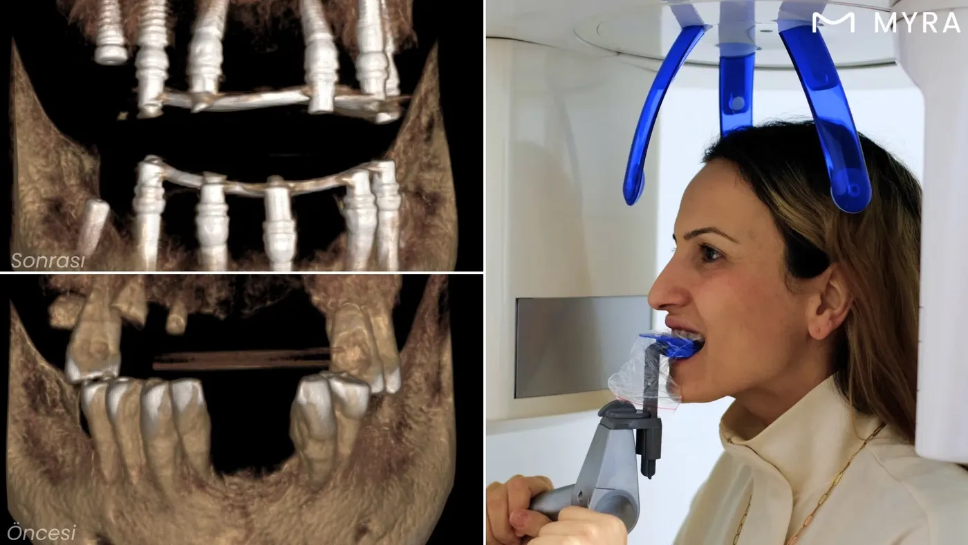 cbct-sonrasi-dijital-model.webp