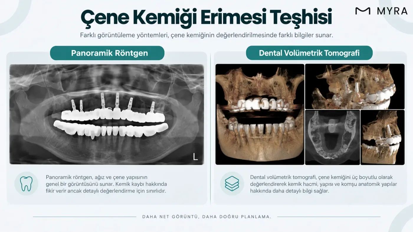 Panoramik röntgen ile dental volümetrik tomografinin kemik kaybı değerlendirmesindeki farkını gösteren karşılaştırma