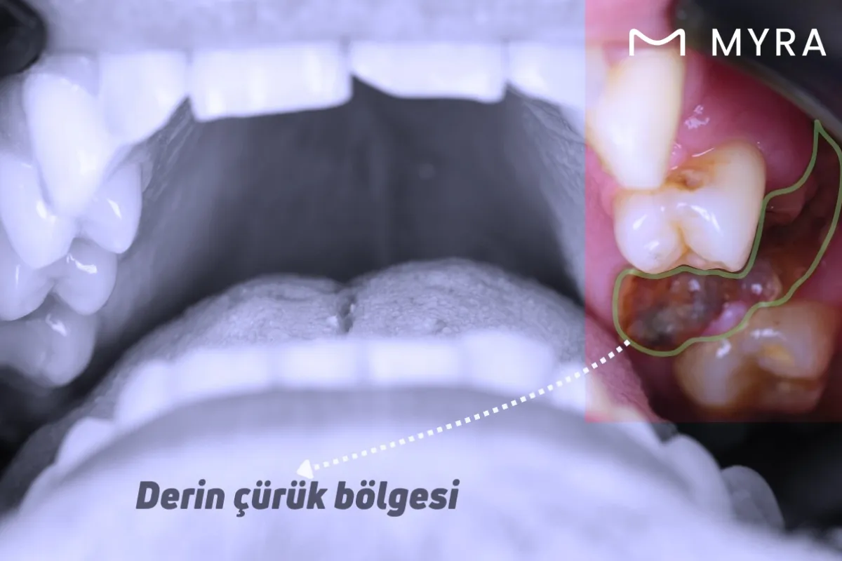 curuk-dis-cene-agrisi.webp