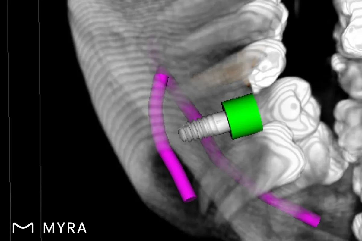 3D tomografi üzerinde implant açısı ve konumu belirleniyor
