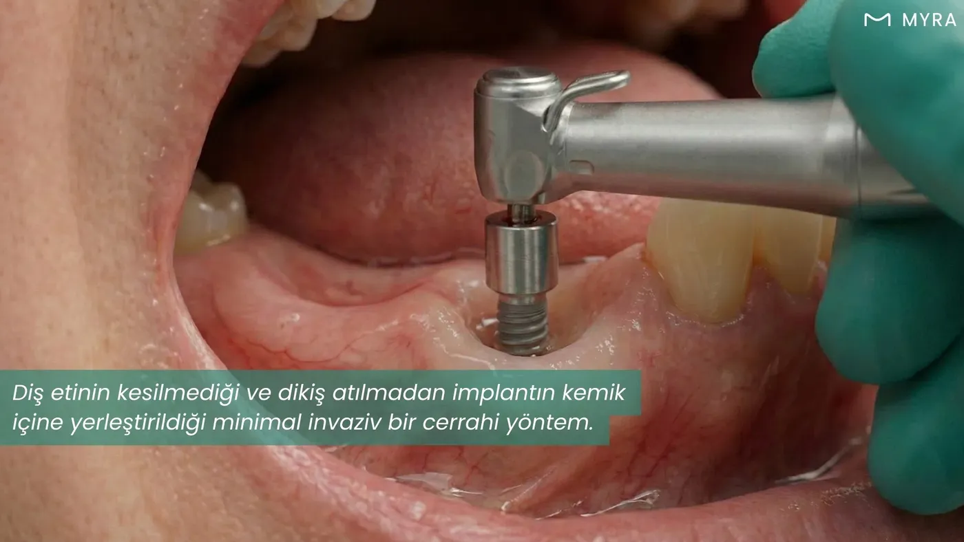 Diş eti kesilmeden punch tekniği ile uygulanan dikişsiz implant cerrahisini gösteren şematik illüstrasyon