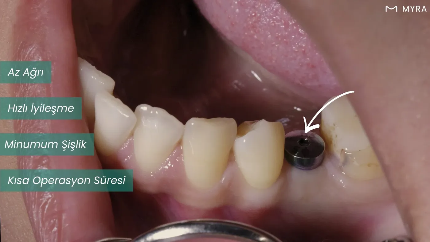 Dikişsiz implant sonrası minimal şişlik ve hızlı iyileşmeyi simgeleyen hasta