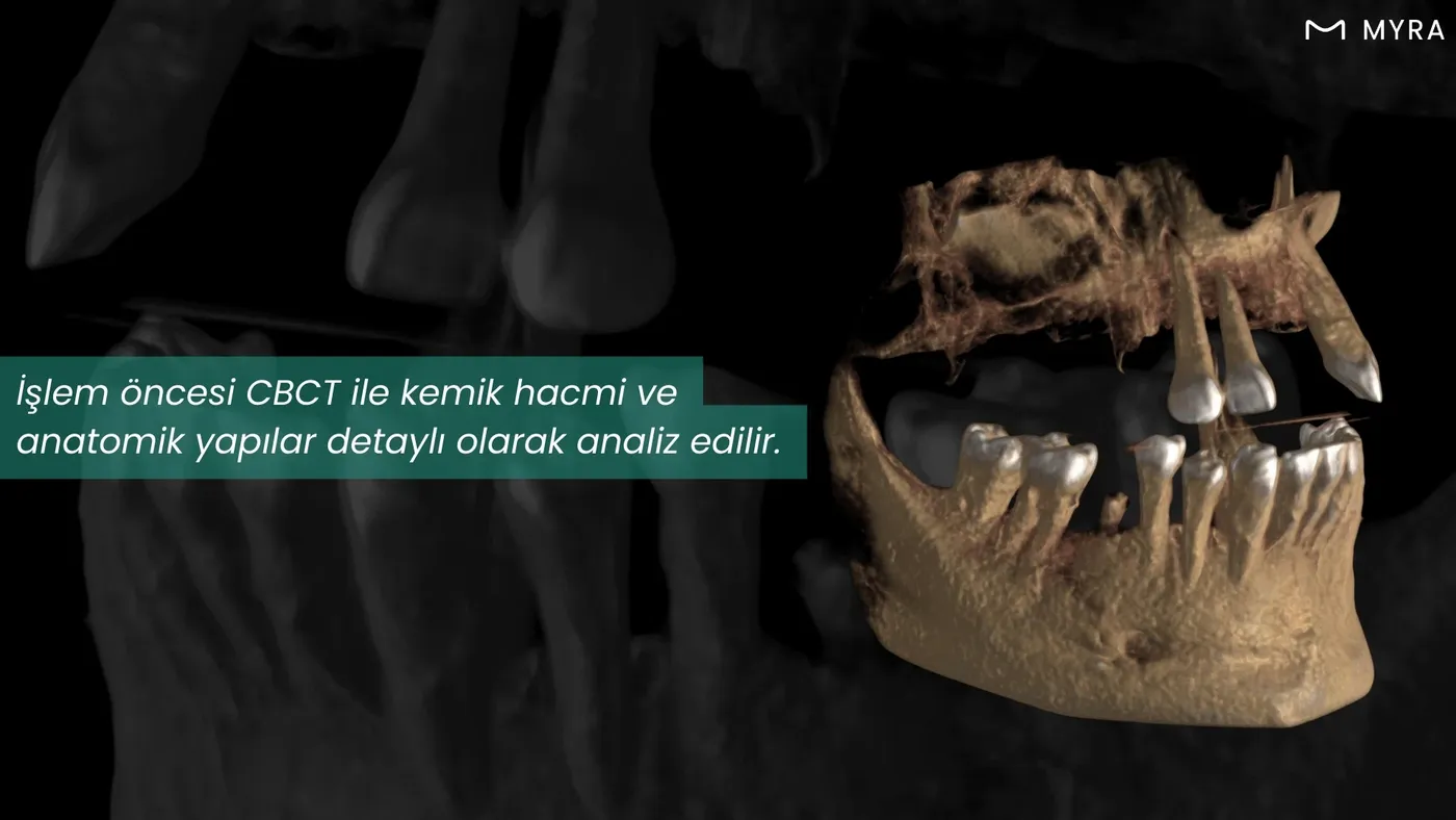 Dikişsiz implant öncesi CBCT ile çene kemiği analizi yapılan 3 boyutlu tomografi görüntüsü