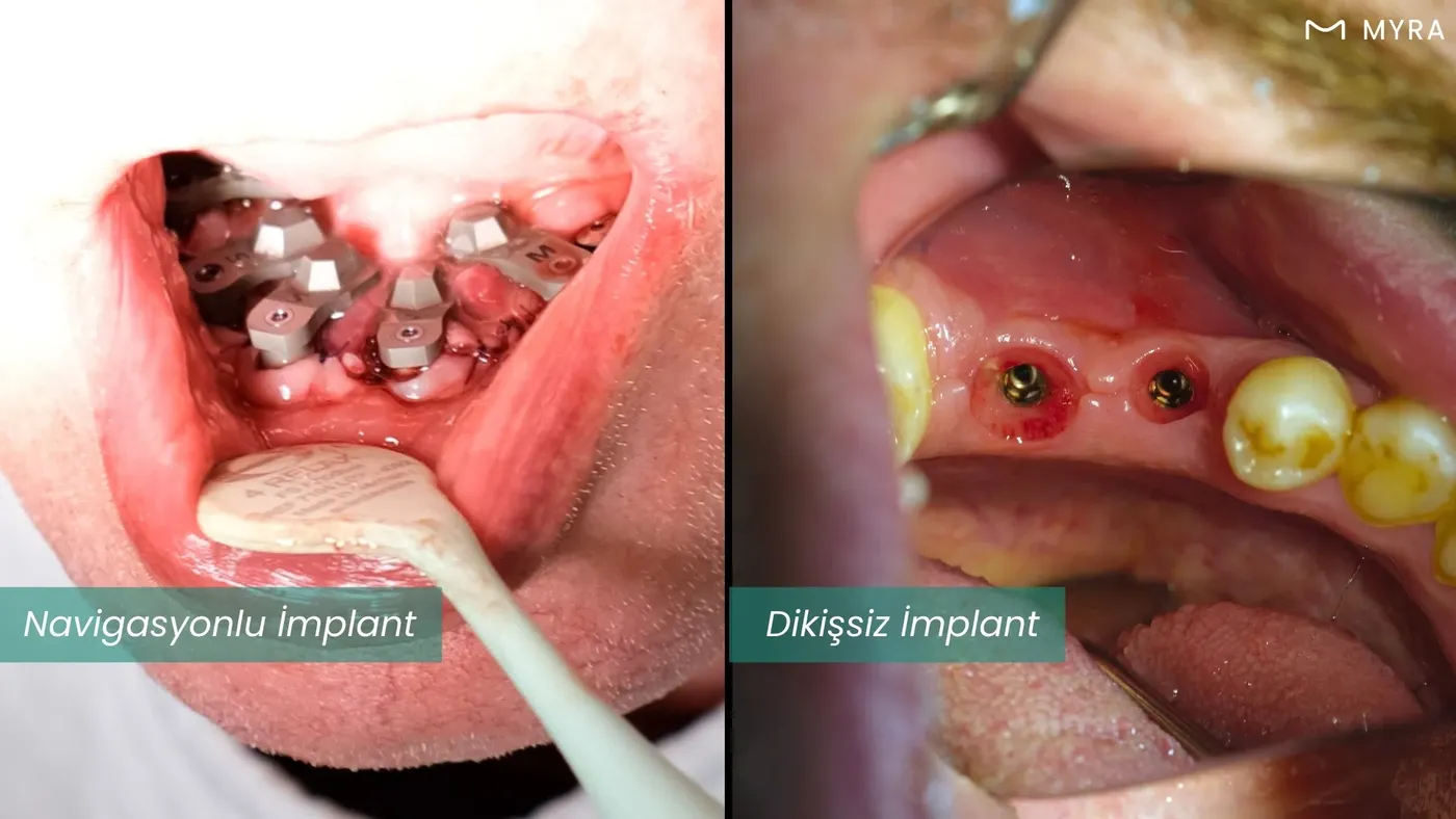 Dikişsiz implant cerrahisi ile navigasyonlu implant planlamasının karşılaştırmalı şematik görseli