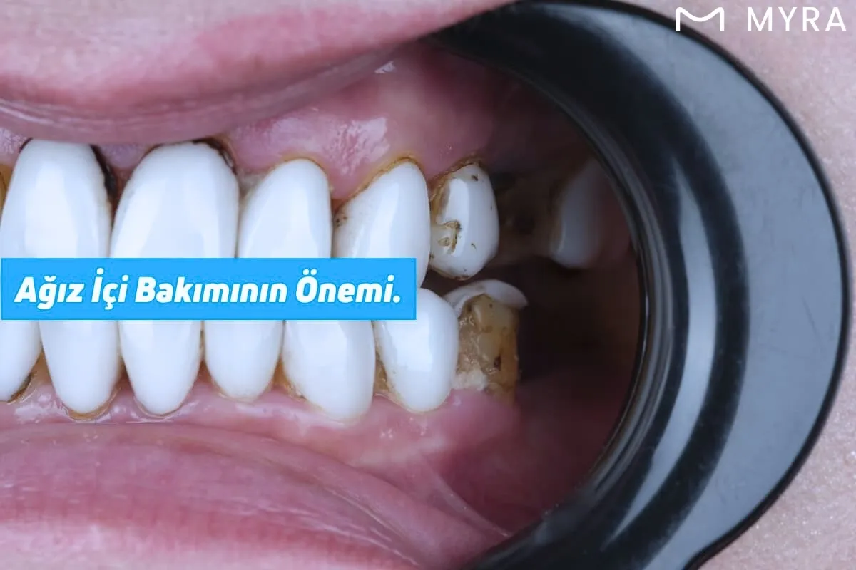 Diş taşı birikimi ve iltihaplı diş etleriyle periodontitis başlangıcı