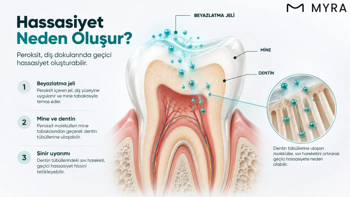 Diş beyazlatma sonrası hassasiyetin nedenleri
