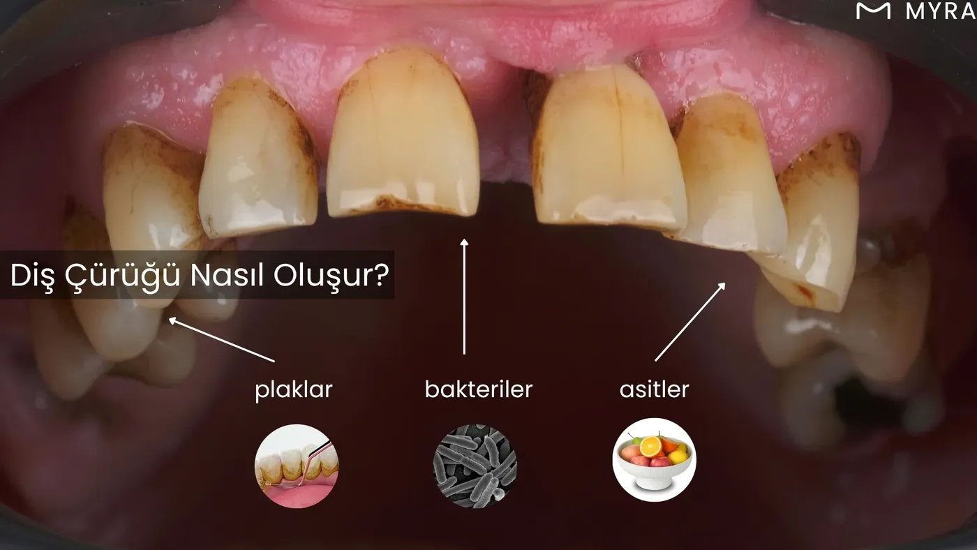Plak, bakteri ve asitlerin diş minesine zarar verdiğini gösteren şema