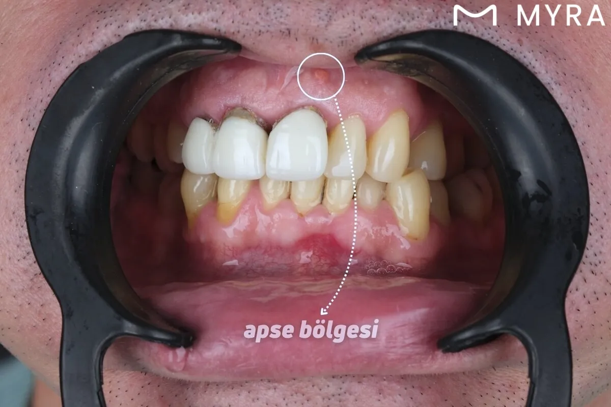 Diş Eti & Periodontal