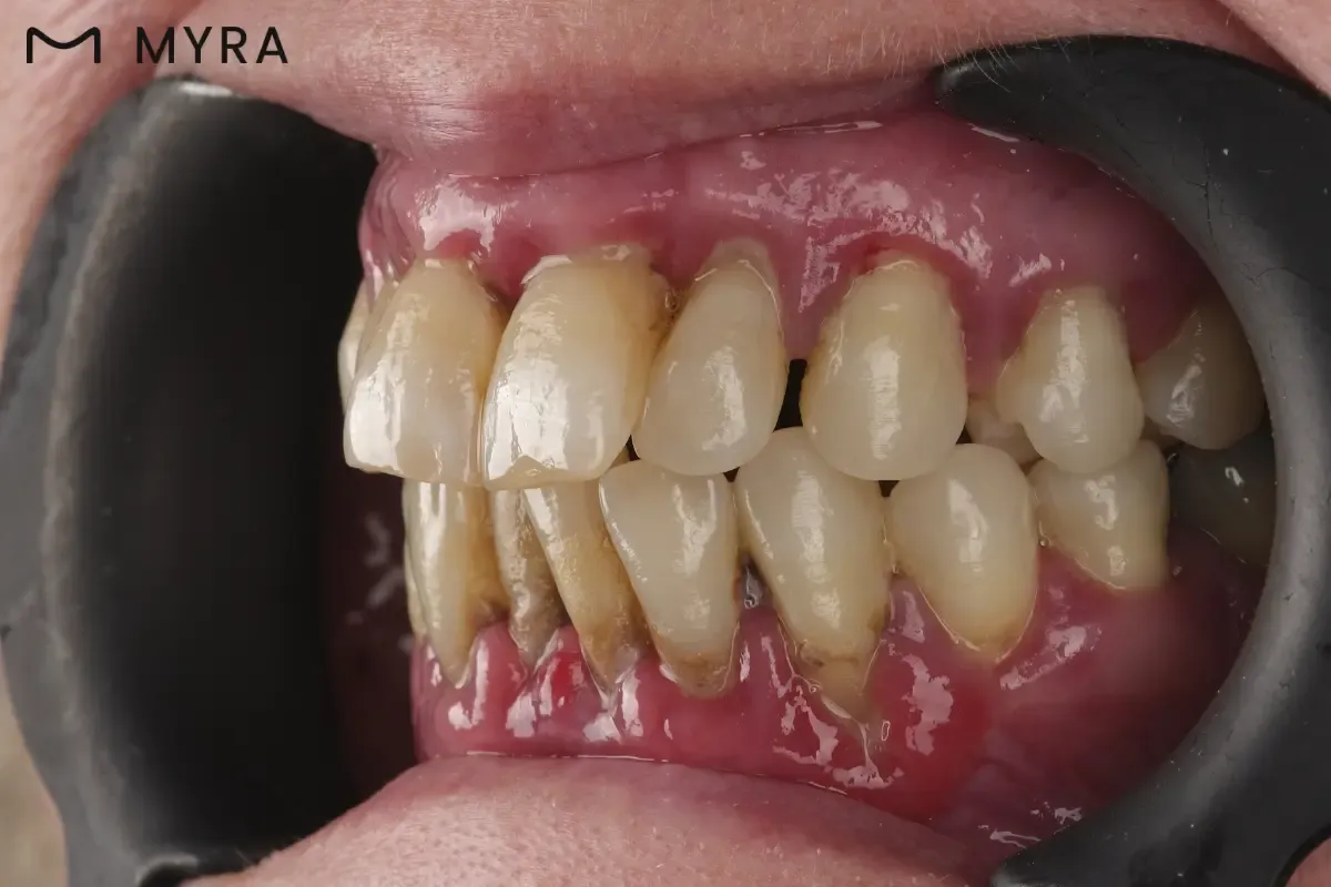 dis-eti-hastaligi-periodontitis.webp