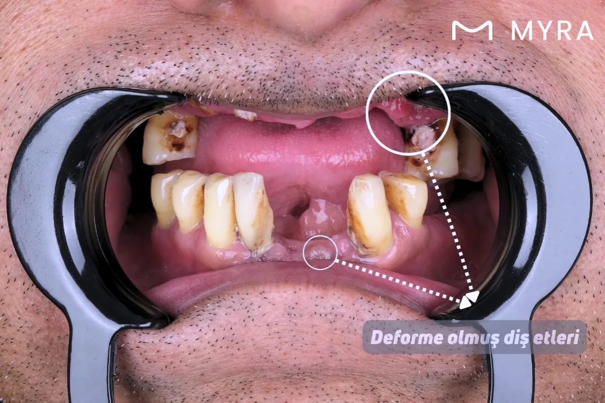 İlerlemiş periodontal hastalıkta diş ve çene görüntüsü