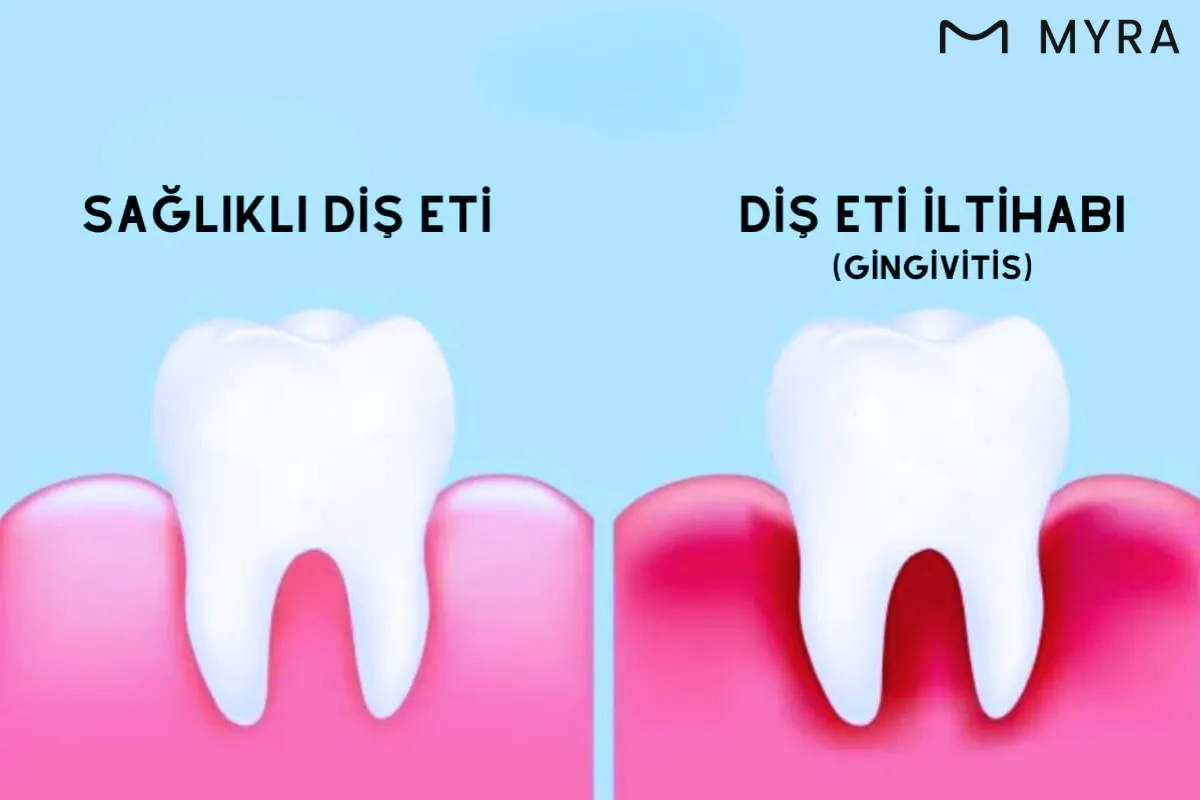 Diş etlerinde şişlik ve kızarıklık gösteren grafiksel açıklama