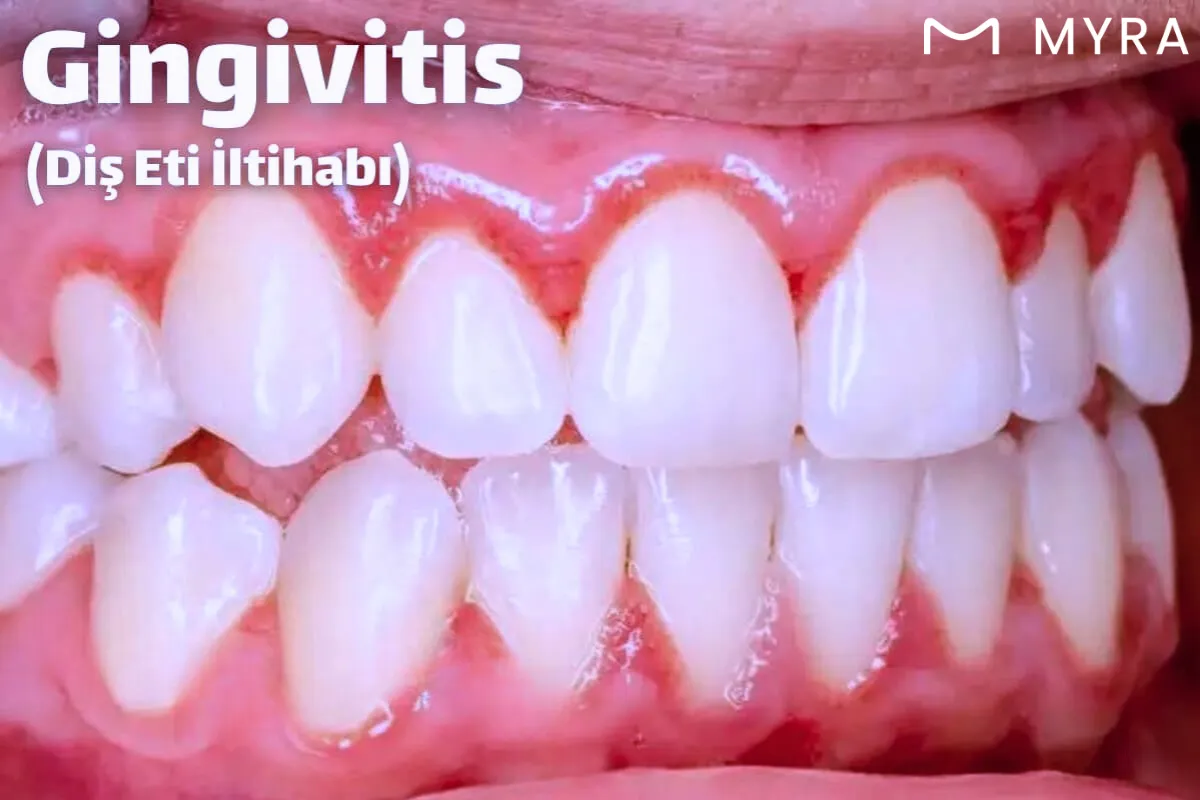 Diş eti iltihabı (gingivitis), diş etlerinin iltihaplanması sonucu kızarıklık, şişlik ve kanama gibi belirtiler gösteren bir diş eti hastalığıdır.