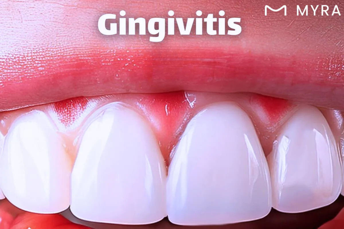 Diş eti iltihabının (gingivitis) belirtileri arasında diş etlerinde kızarıklık, şişlik, kanama ve hassasiyet bulunur.