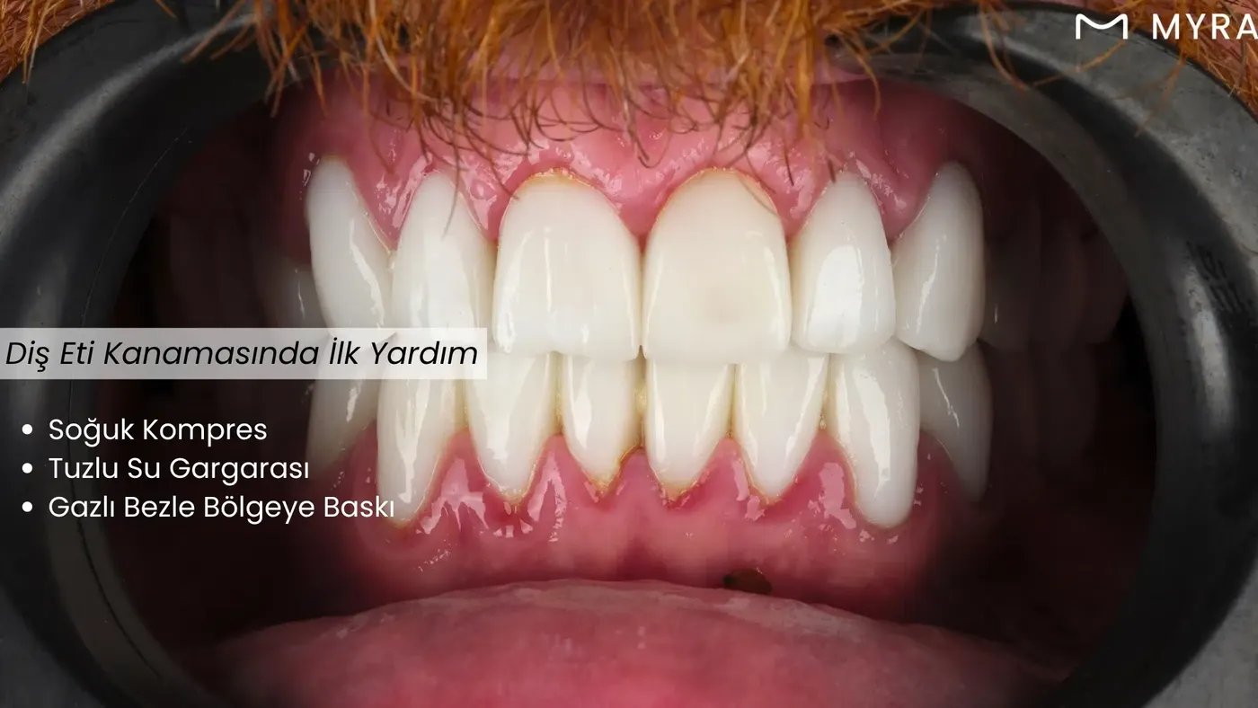 Diş eti kanamasını durdurmanın yolları