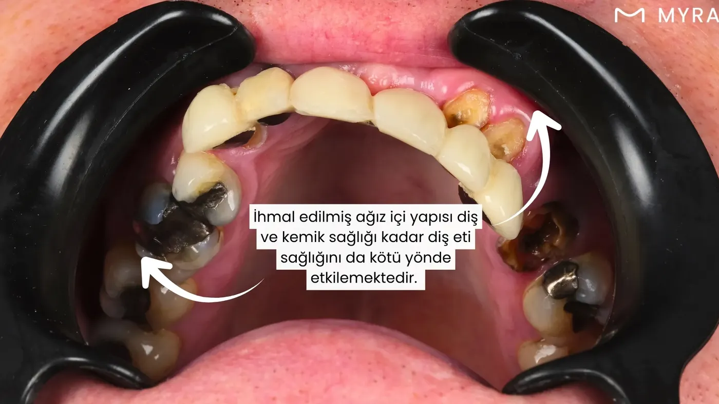 Diş eti kanamasının tehlikeli belirtileri