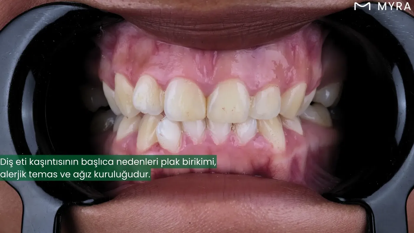 Diş eti kaşıntısının başlıca nedenleri: plak birikimi, alerjik temas ve ağız kuruluğu