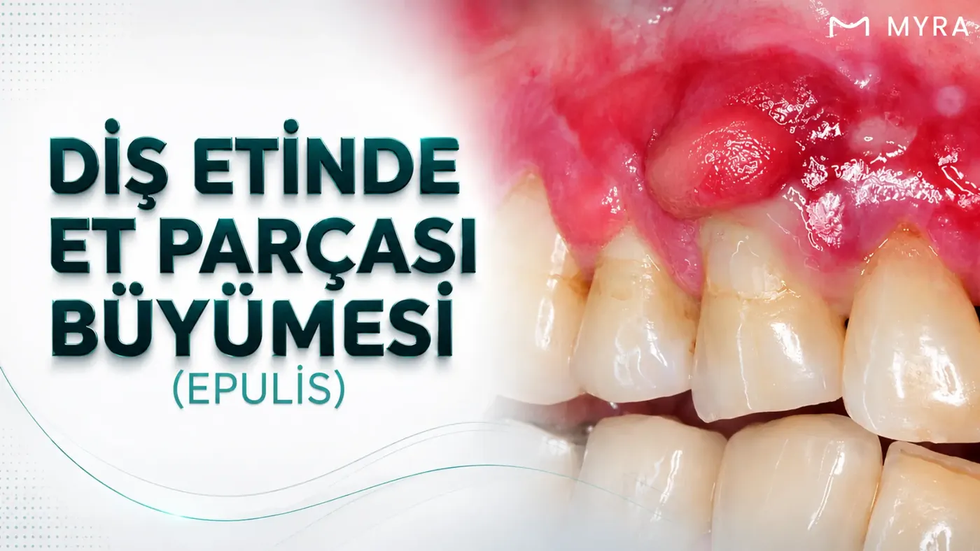 dis-etinde-et-parcasi-buyumesi-epulis.webp