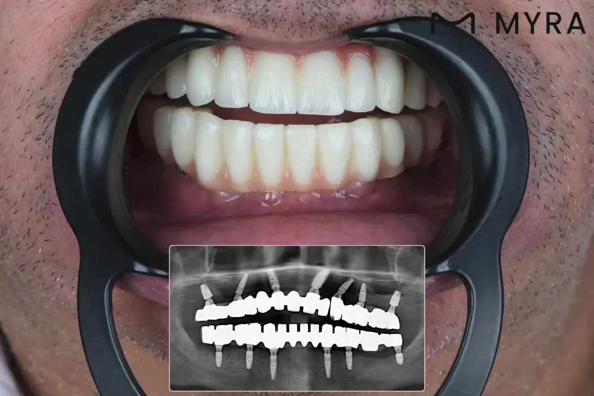 dis-implantinin-yan-etkileri-all-on-4.webp