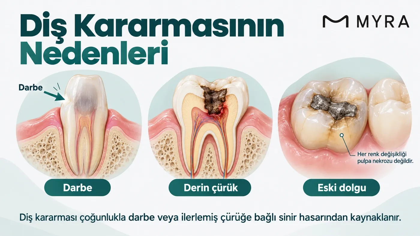 Darbe, derin çürük ve eski dolgu gibi diş kararmasına yol açan nedenleri gösteren görsel