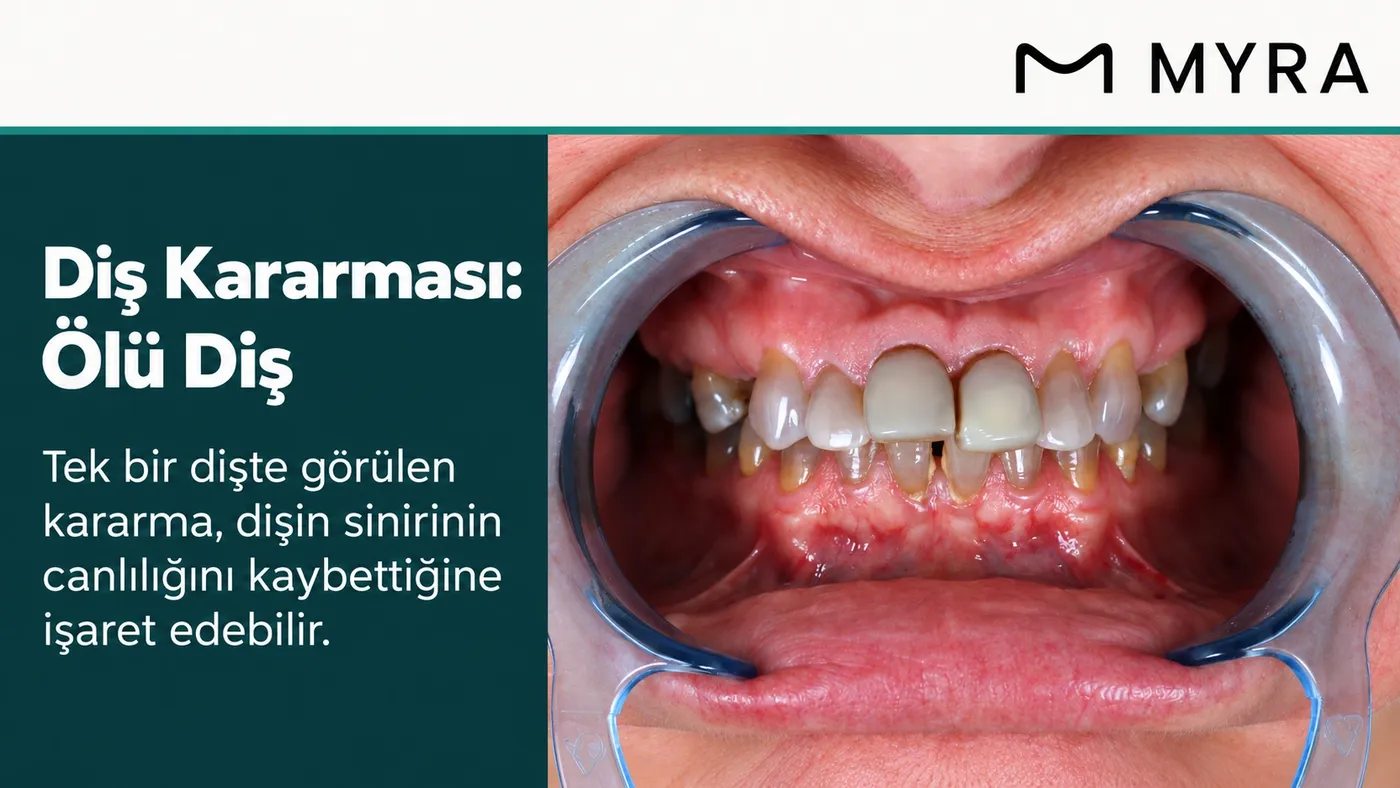 Ön dişlerden birinde pulpa nekrozuna bağlı gri-kahverengi renk değişikliği görülen diş kararması