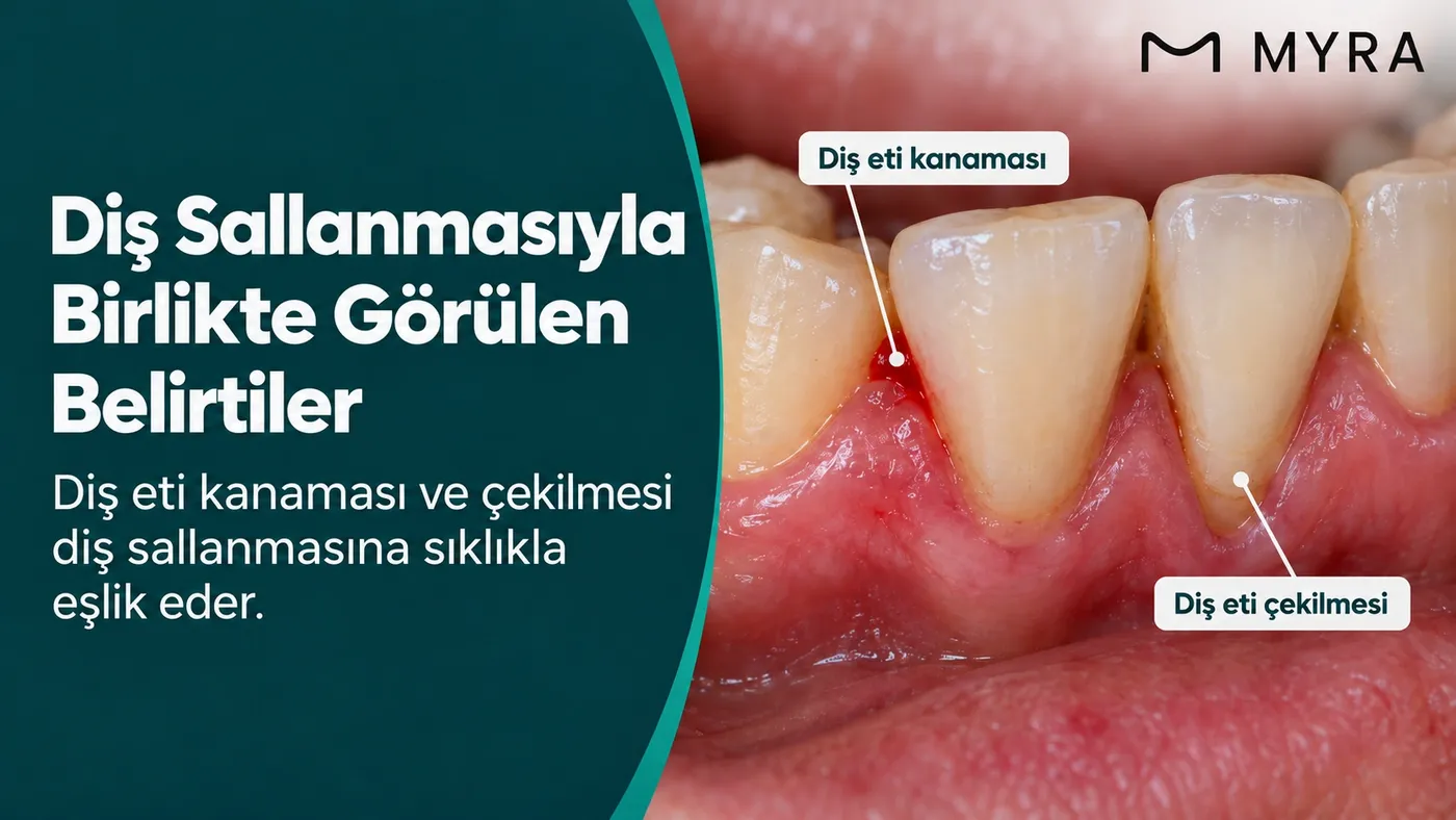 Diş sallanmasıyla birlikte diş eti kanaması ve çekilmesi
