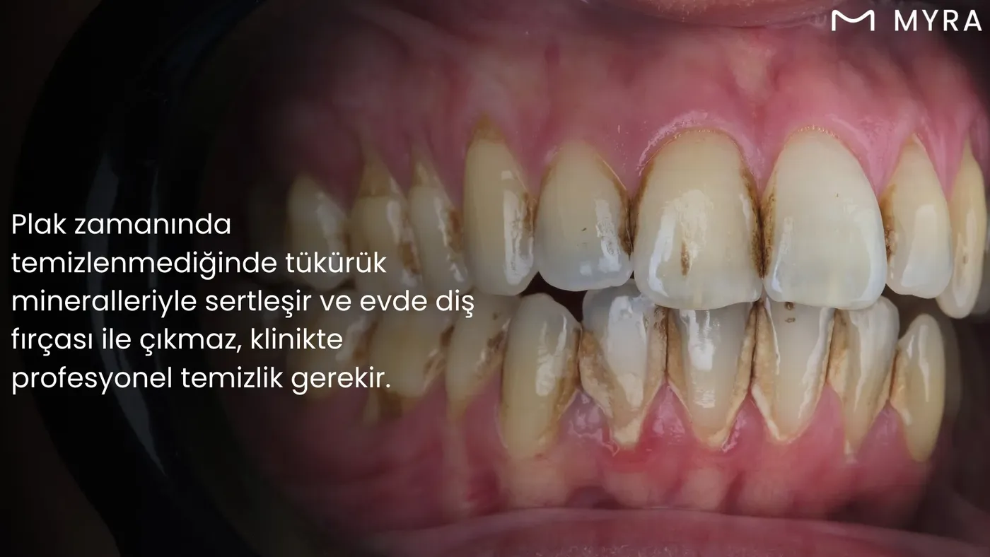 Diş eti çizgisi üzerinde sarı-kahverengi sert diş taşı birikiminin yakın plan görüntüsü