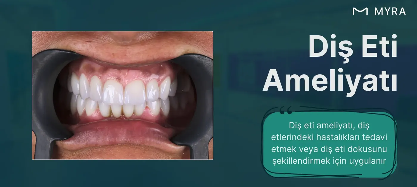 diş-eti-ameliyati-oncesi-sonrasi.webp