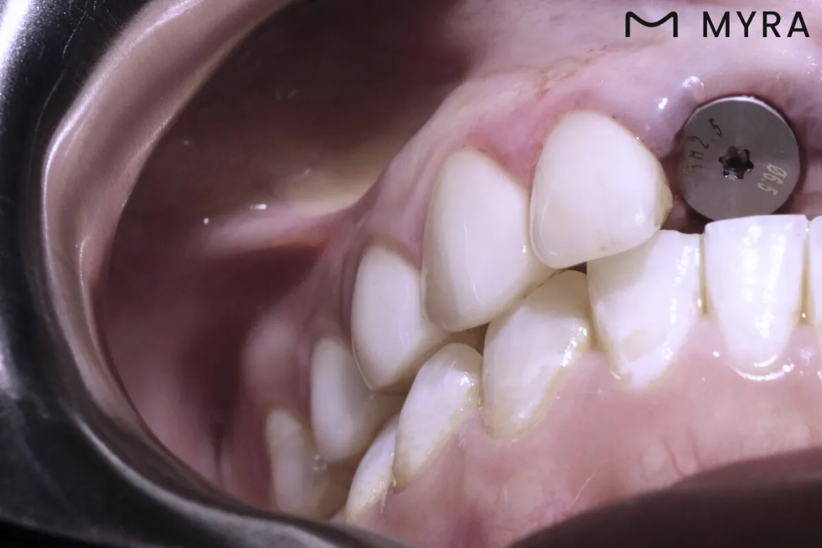 Ön bölgede eksik dişin bulunduğu çene yapısı implant öncesi