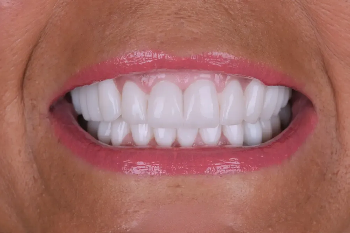 gummy-smile-2.webp